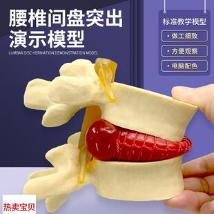 人体脊柱模型脊椎骨头腰椎间盘模具椎体模型突出受压X病理骨质教