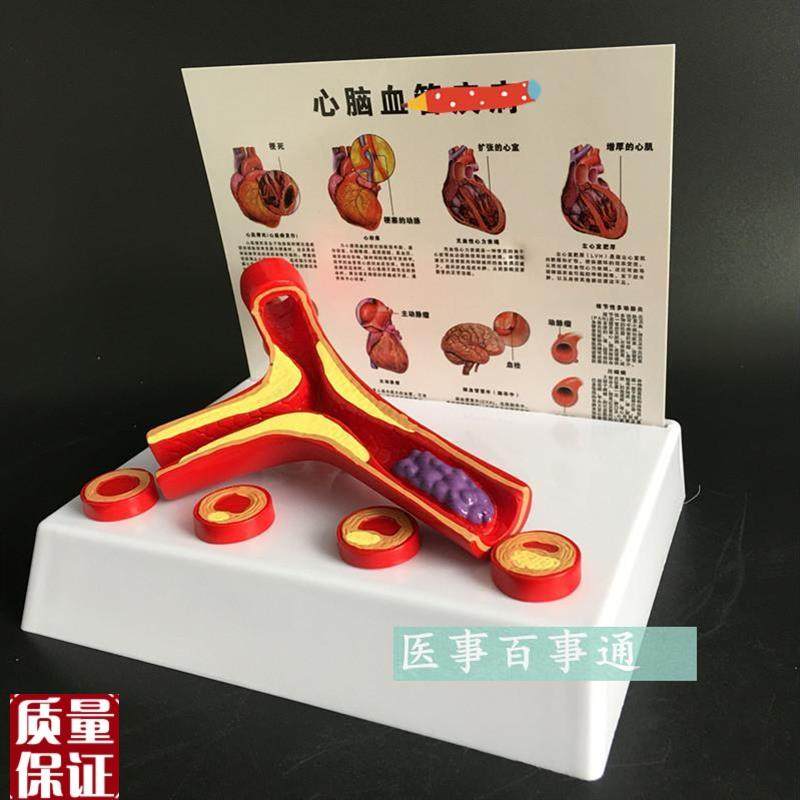 动脉模型硬化f带血栓模型动脉血管粥样硬化带血栓病变器官内脏模