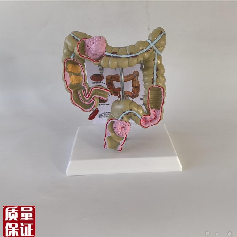 带说明肛a肠病理人体结肠病变模型大肠模型大肠病态内脏消化科教