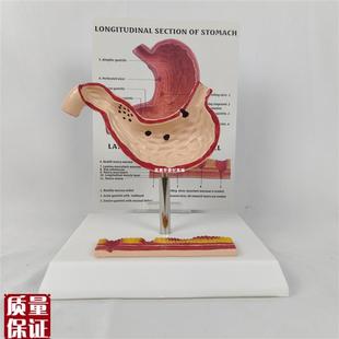 人体病理胃模型胃穿孔胃病胃溃疡病态胃消化科胃冠状.腹腔解剖教