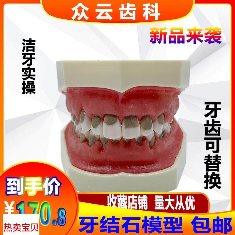 牙科口腔练习牙结石龈上龈下z刮治模型牙结石牙周病理牙齿模型