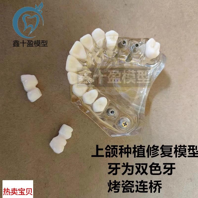 牙科种植模型2011上颌种植z解说义齿修复烤瓷连桥种植钉模型