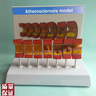 动脉粥样硬化模型血管血栓栓塞模型动脉血管人体医用Z医学教学教