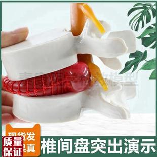椎间盘压迫神经演示模型突v出脊骨劳损骨质密度变化疏松变脆老年