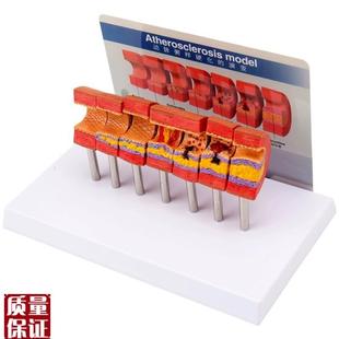 心脑血管堵塞动i支脉粥样硬化血栓血液浓度脂肪病理教学用模型道