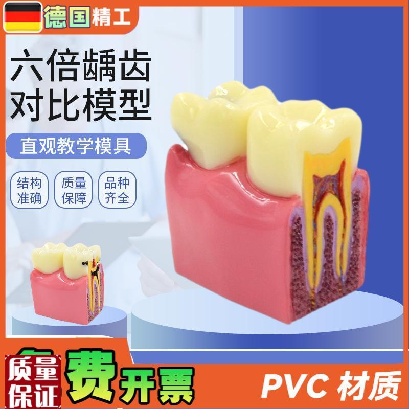 德国】六倍龋齿对比模s型口腔牙齿模型口腔教学蛀牙切面模型