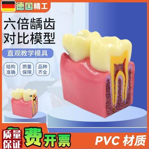 德国】六倍龋齿对比模s型口腔牙齿模型口腔教学蛀牙切面模型
