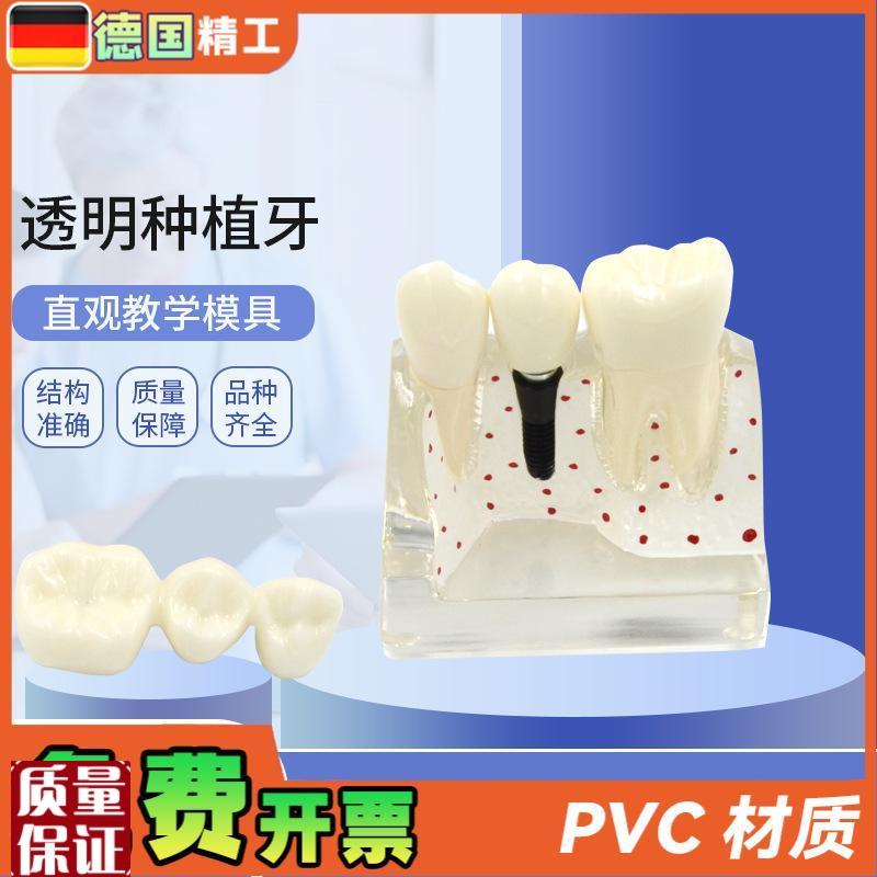 德国】透明种植牙模型牙科修复模型透明可拆W卸病理种植体