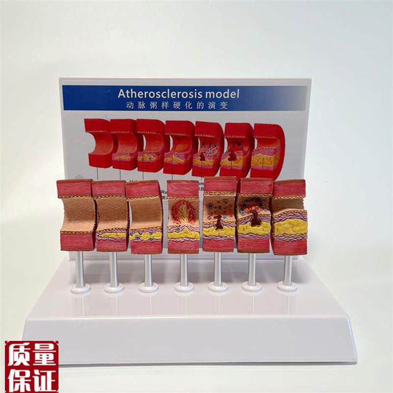 动脉血管模型h粥样病理硬化血管壁变细狭窄内膜斑块沉积阻塞程度