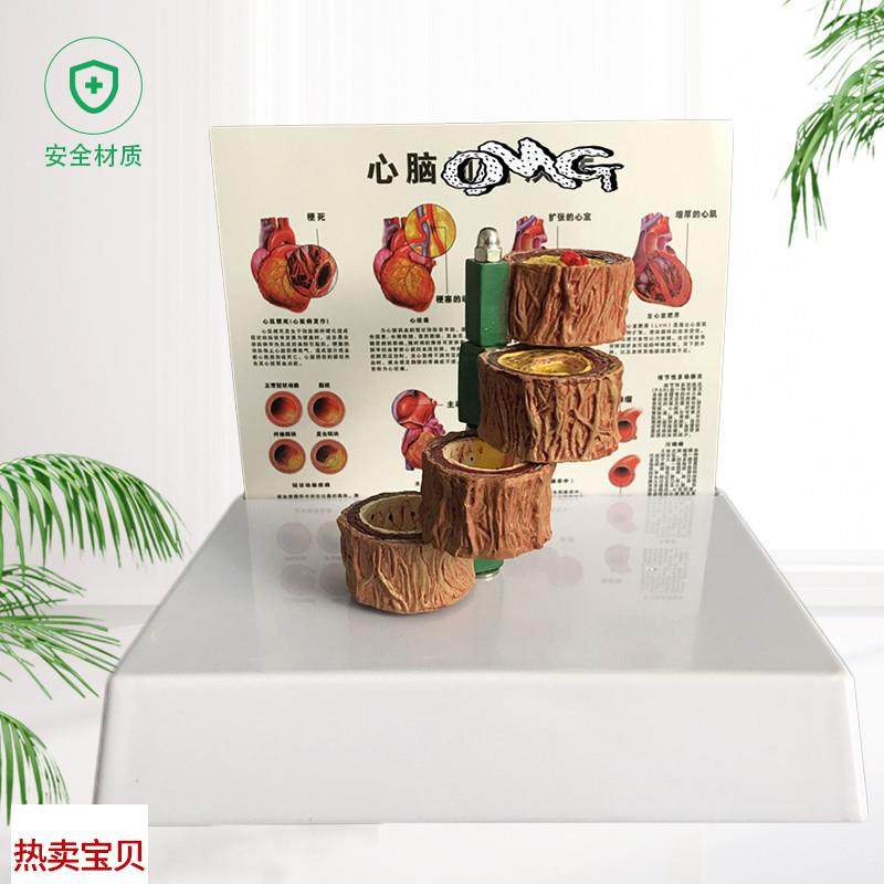 动脉粥样c硬化模型血栓病变模型血管病演示心脏模型血管病理