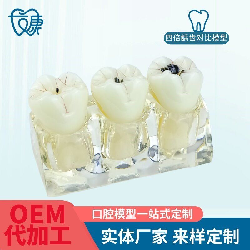 牙科教学用四倍龋齿模型 商用牙模型教学器材 口腔护理教.学透明