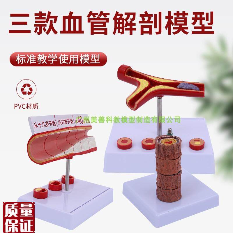 血管/堵塞动支j脉粥样/硬化心血管动脉/硬化模型血管病理模型血