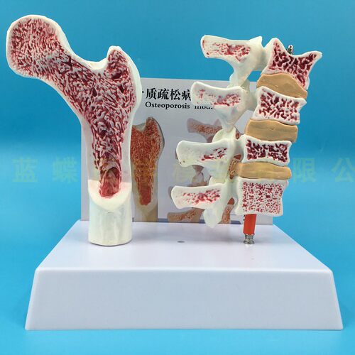 人体股骨a骨质疏松解剖模型腿骨解剖面 脊柱切面标本 病变腰椎模
