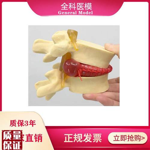 腰椎间盘突出模