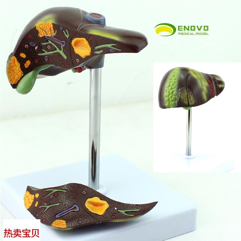 ENOVO颐诺乙肝肝炎脂肪肝肝硬化肝脏H模型消化科医学肝胆保健模型