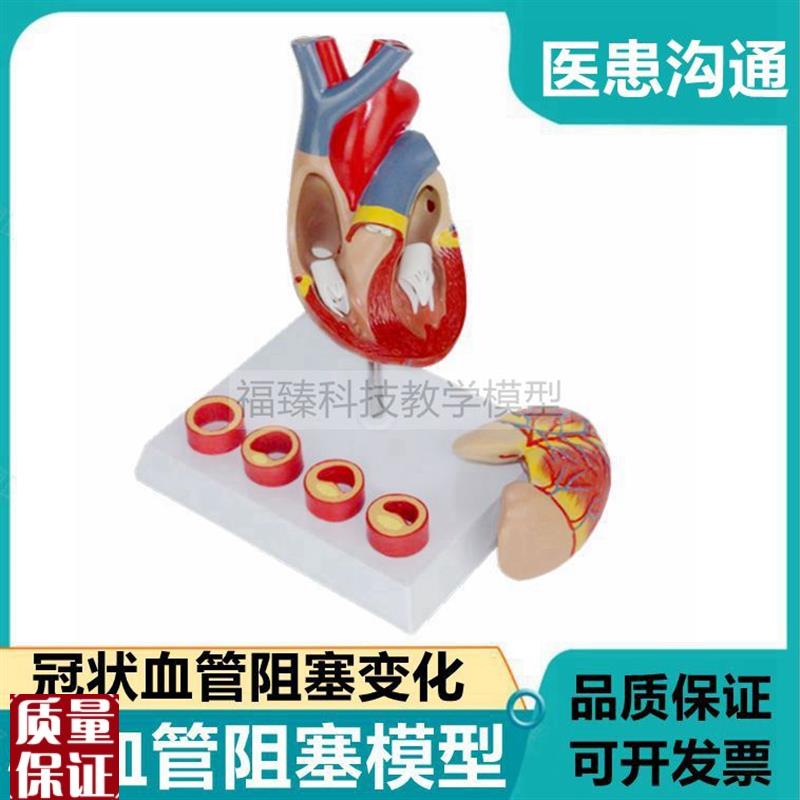 人体心脏血管阻塞模型冠状动脉狭窄粥样L斑块病理心脏医患沟通礼