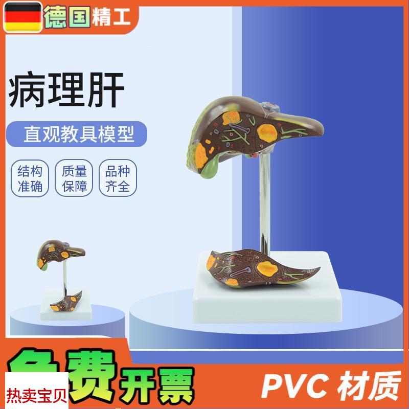 德国】肝脏病理病理t肝模型结石胆模型肝演示病理胆囊