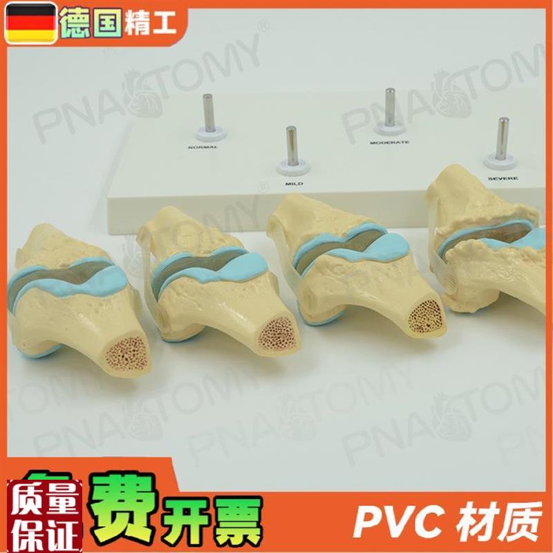 德国】人体膝关节骨骼/病理模型关节骨质/病R变教学膝盖骨外科