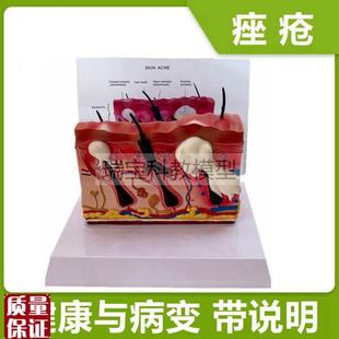 痤疮皮肤模型病理面部皮肤结构毛囊E人体皮肤解剖医美整形医用教