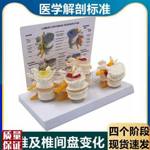 腰椎模型椎间盘受压突出演示老年人脊椎劳损病Q理比较椎骨正骨推