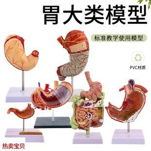 病理胃模型人体胃的穿孔病态胃模型消化科胃冠V状剖面解剖放大