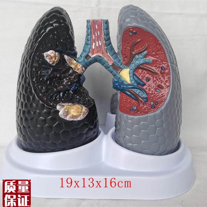人体吸烟c癌变肺模型健康肺模型人类内脏吸烟肺与健康肺模