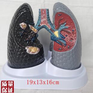 人体吸烟c癌变肺模型健康肺模型人类内脏吸烟肺与健康肺模