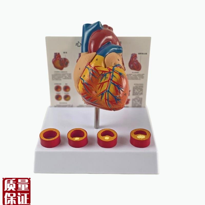 康泰模型a心血管粥样硬化狭窄阻塞病理冠状动脉临床医药促销人体