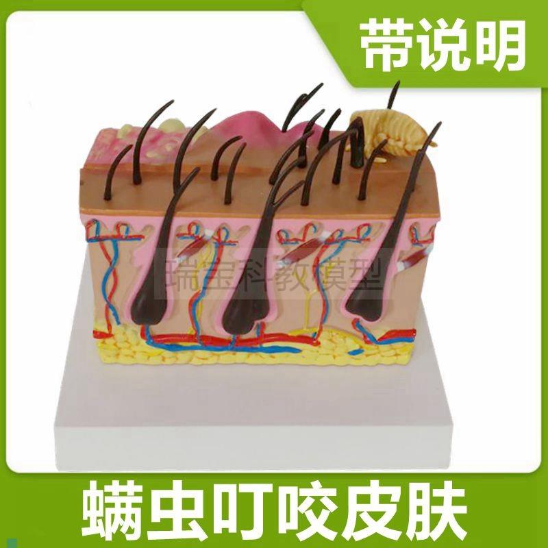 皮肤模型病d理蚊虫叮咬过程皮下病变医美微整形皮肤美容带说明礼