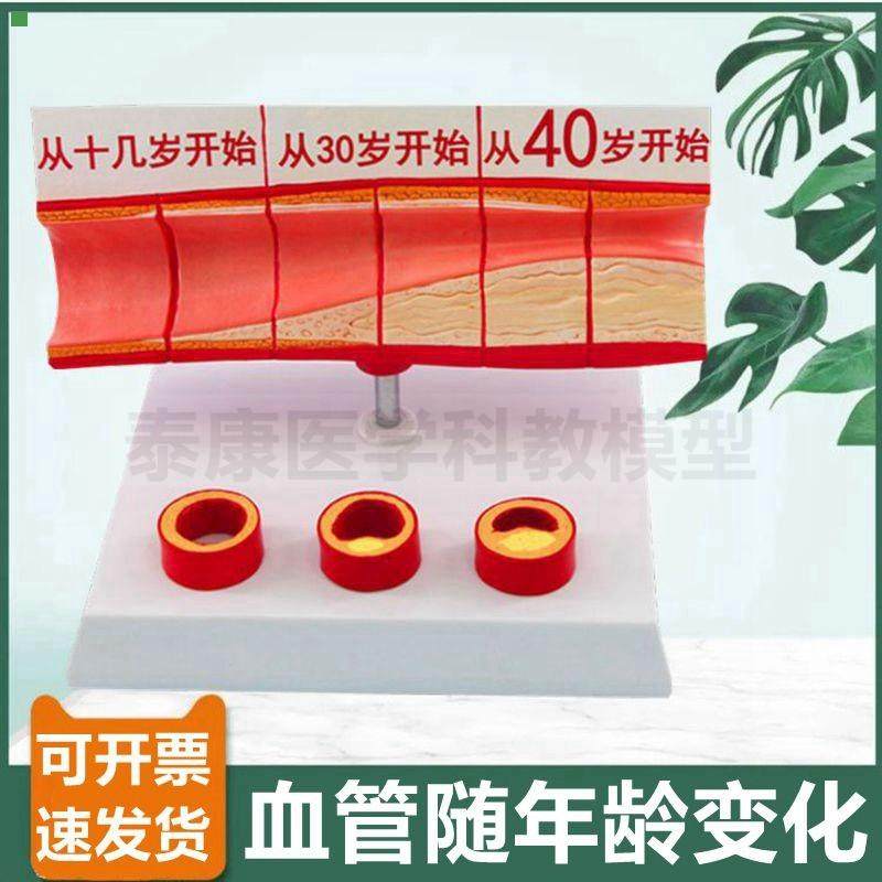 中老年人血管模型 内膜受损粥样斑块栓子硬化阻塞管腔狭窄心血管