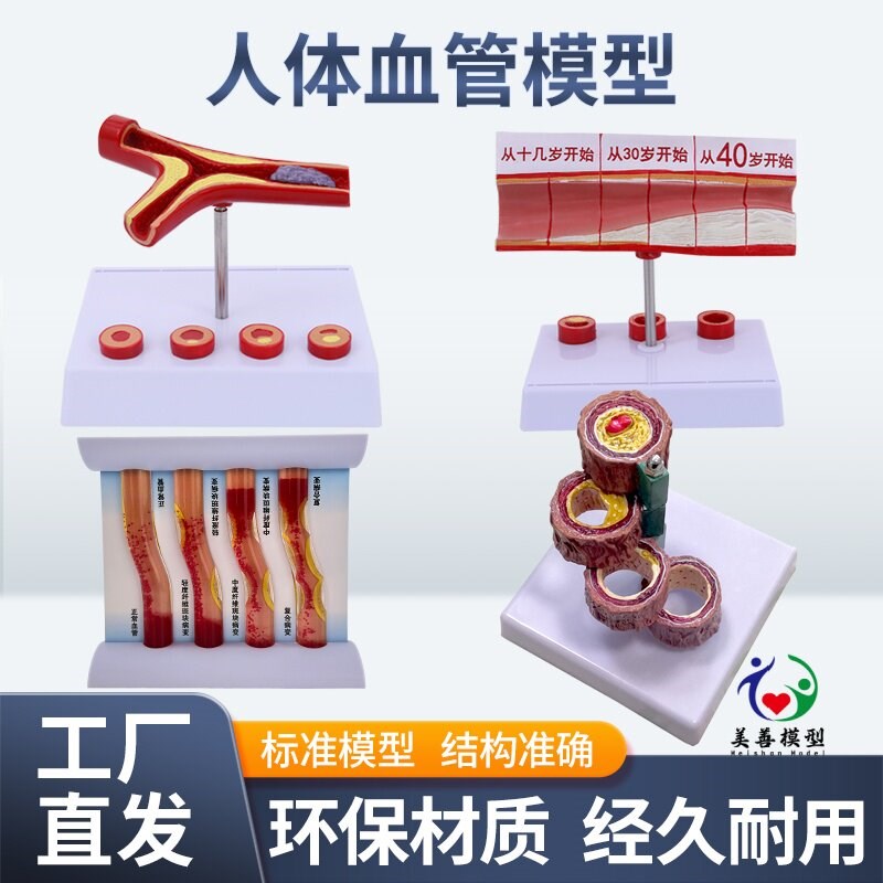 血管/堵塞动支脉粥样/硬t化心血管动脉/ 硬化模型血管病理模型血