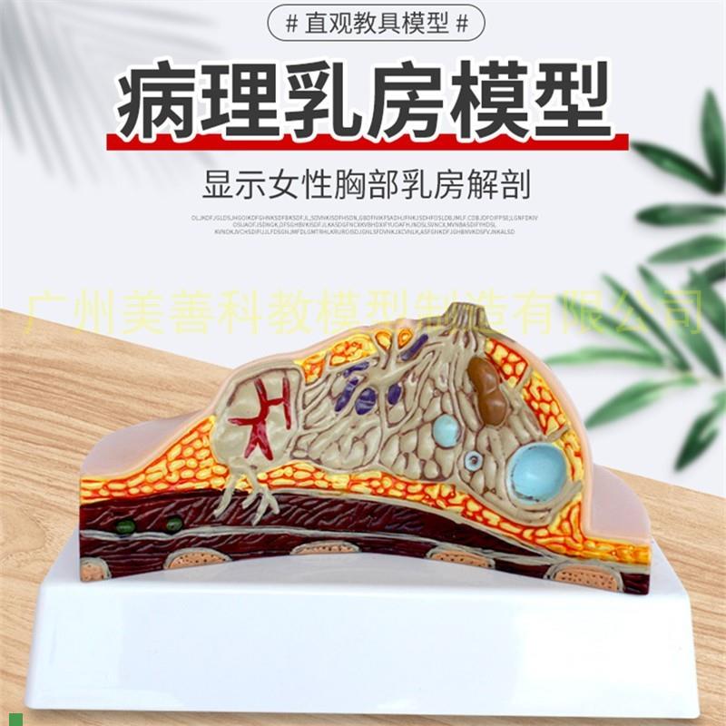 病态女性乳房模型病理乳腺解剖模型女性生P殖科普教育教学健康