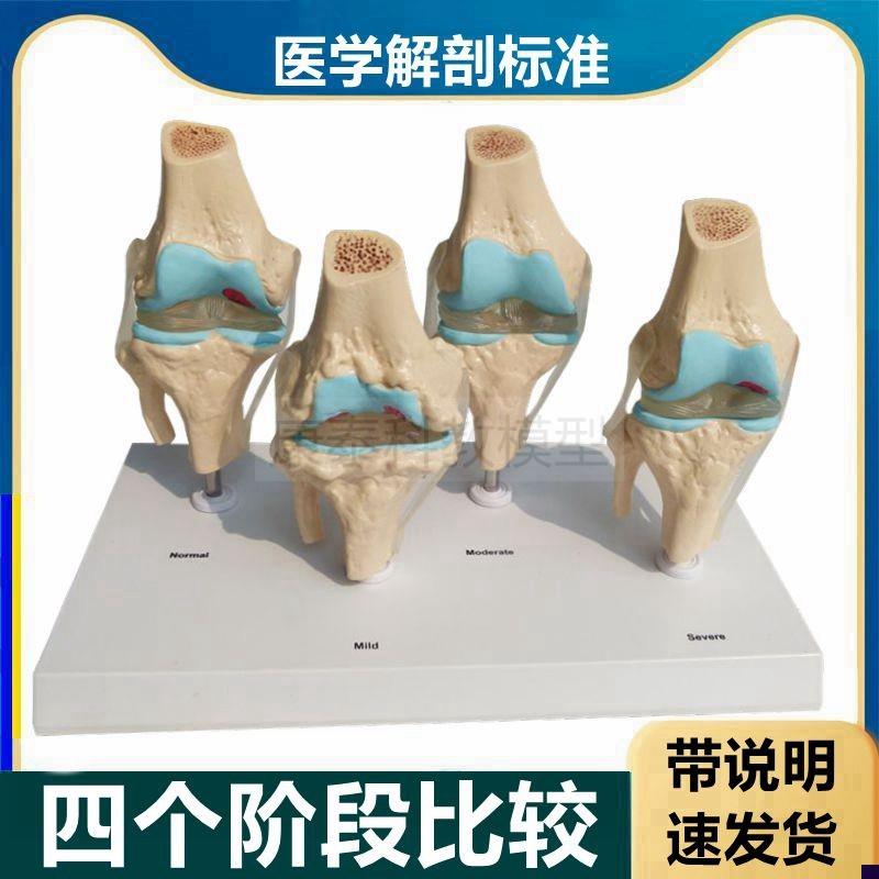 人体膝关节模型半月板损伤软骨磨损骨赘年龄N段膝盖变化韧带医患