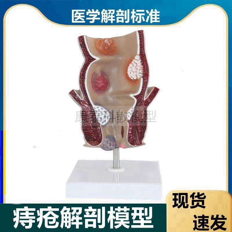 人体直肠模型肠道保健肛肠科大肠消化系L统肛周痔疮结肠肉突出