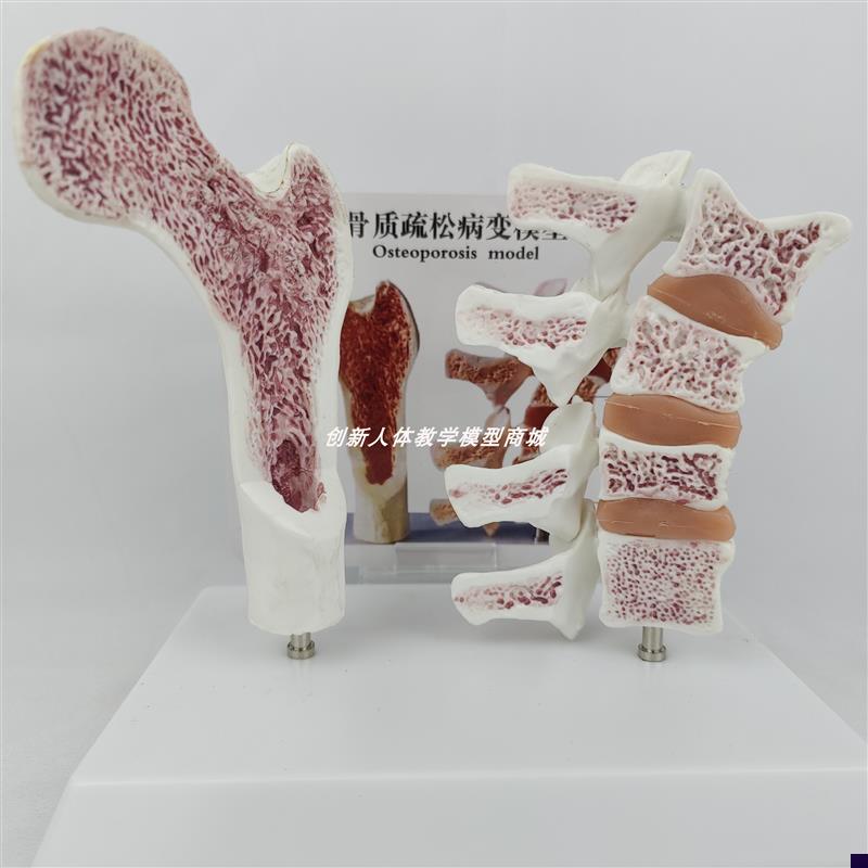 人体股骨头脊柱脊椎解剖切面对比B模型骨质疏松病变医学用骨骼骨