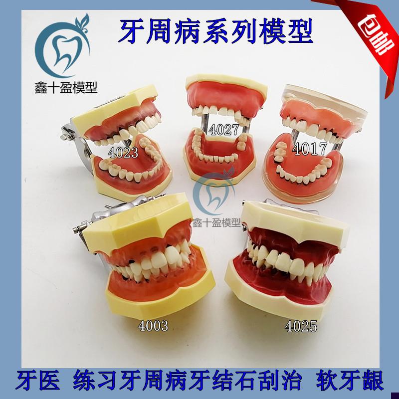 牙科口腔教学模型 牙周病理模型 练习刮治结石P 牙周分类医患沟通