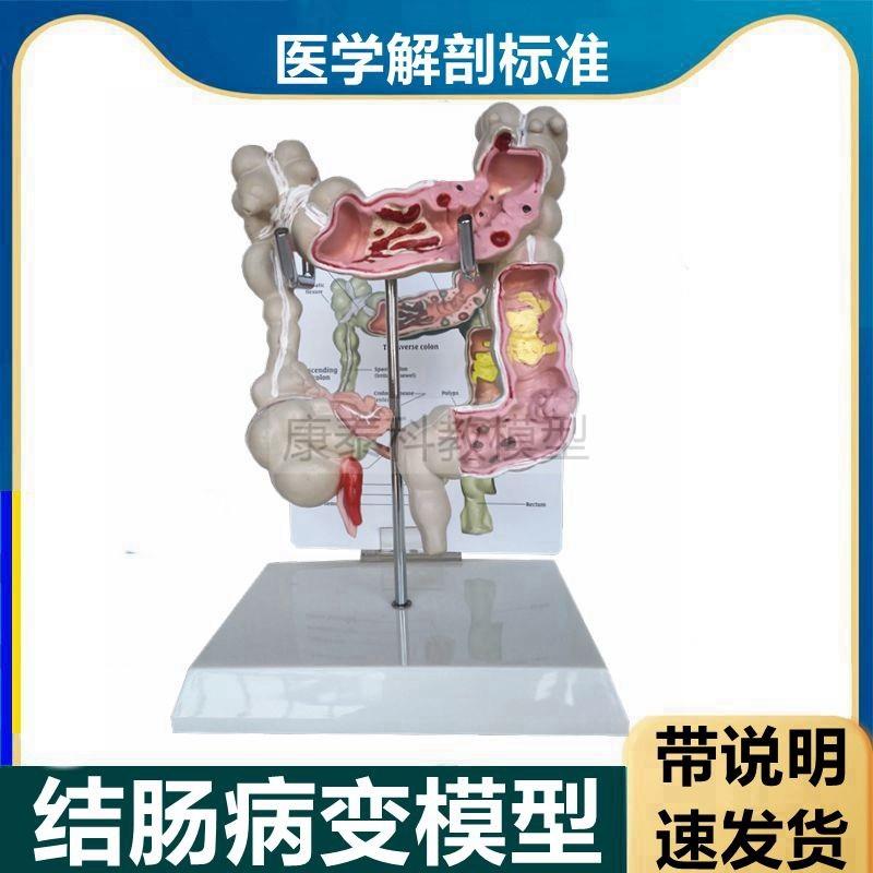 人体结肠模型病理肉突p出盲肠阑尾肛肠科医患消化系统大肠直肠医