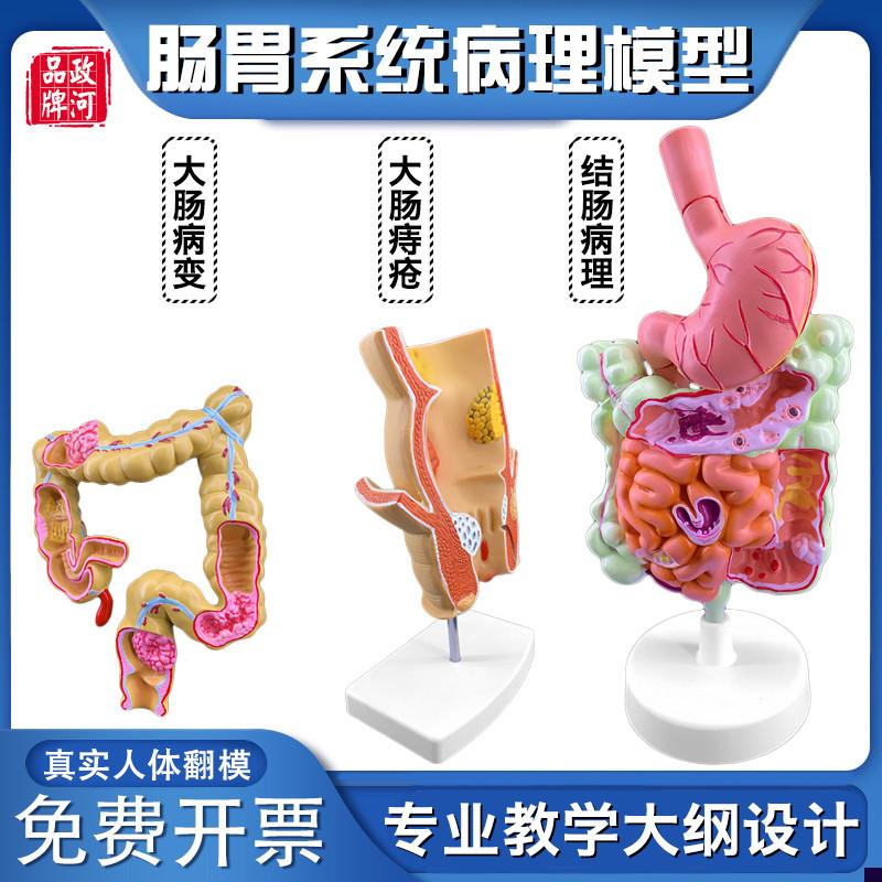 政河人体大肠病理痔疮展示结肠解剖E器官结构模型十二指肠胃系统
