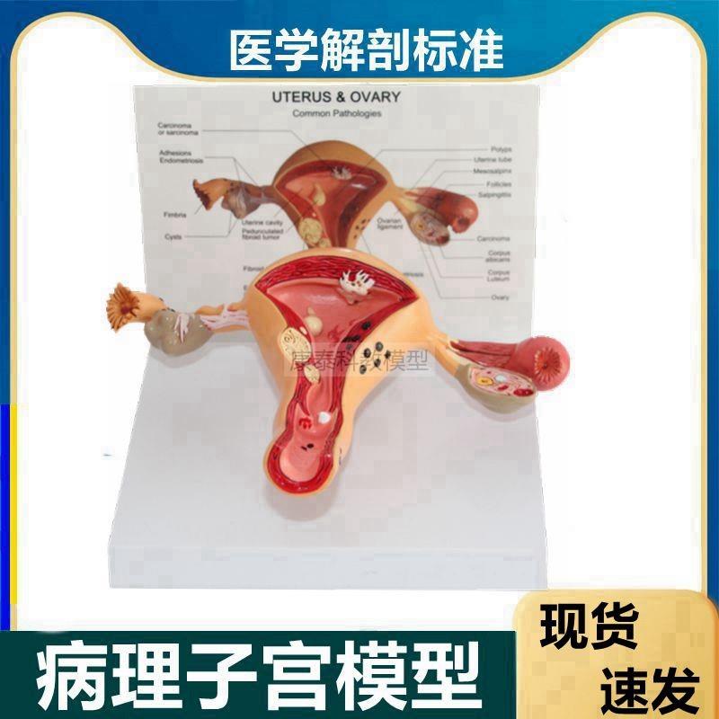 子宫模型正常结构病p理变化卵巢输卵管生殖阴道妇科医患诊所摆