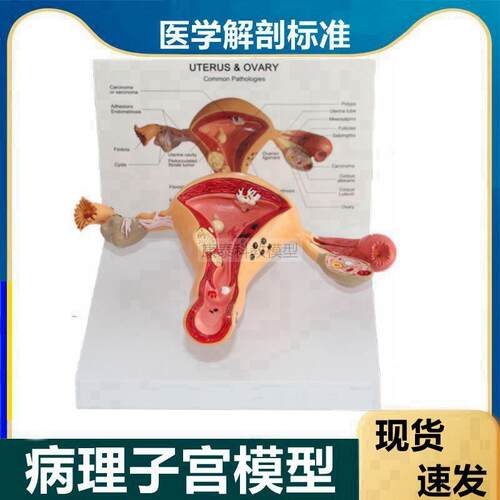 子宫模型正常结构病p理变化卵巢输卵管生殖阴道妇科医患诊所摆