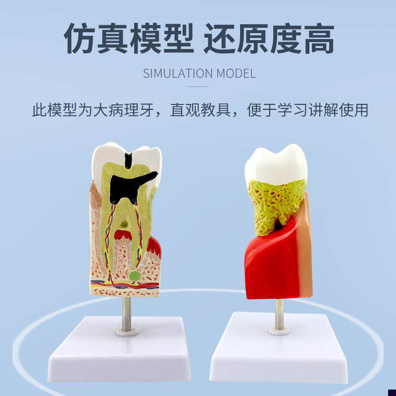 蛀牙模型 牙齿病综合病理模w型 牙齿解剖剖面模型 齿科医患沟通