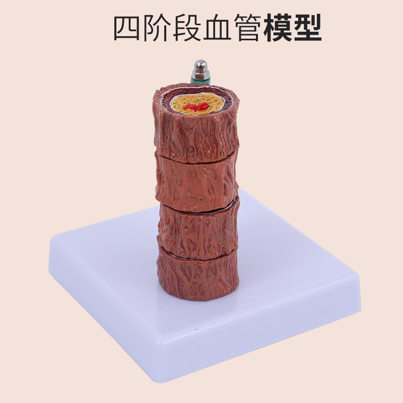 硬化粥样人体支脉血管解剖模型心内K科教学心血管动脉梗化玩