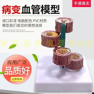 硬化支脉粥样血管模型 心u血管动脉解剖模型 人体病态血管模型血