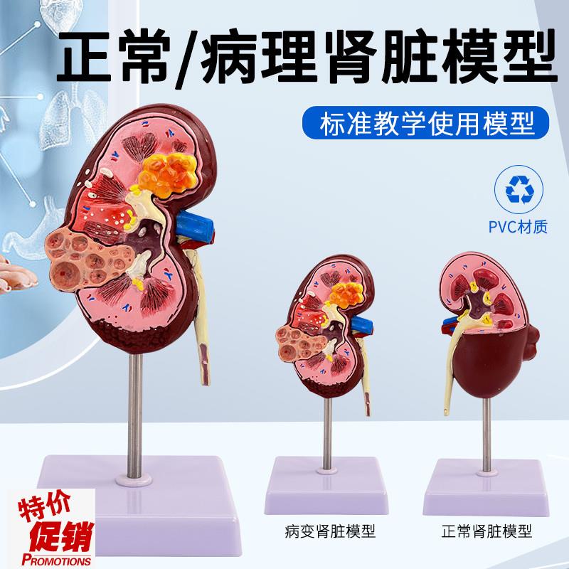 人体肾解剖模型病变肾脏模型病态肾脏人体内脏器.官解剖模型