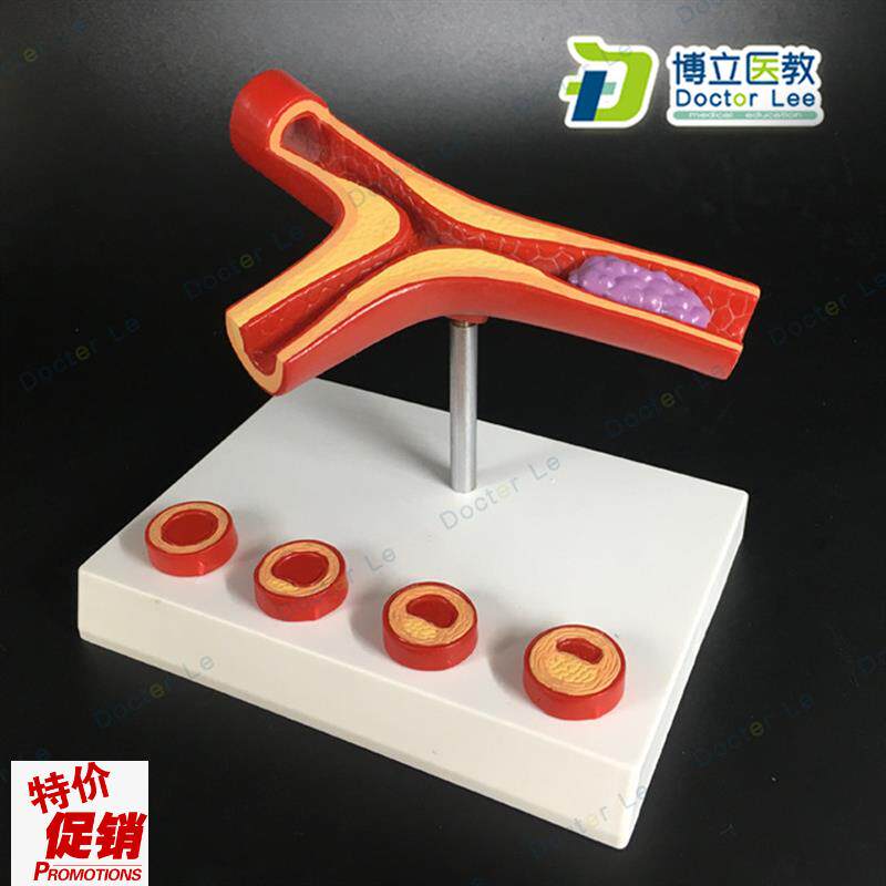 血管堵4塞血液浓m度脂肪病理血液血管粥样血管病理解剖模型