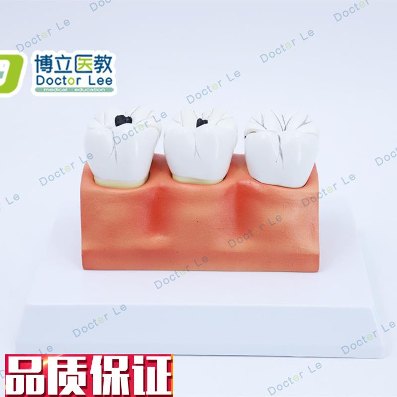 教学仿真龋齿模型l牙齿模型病变牙齿模型3颗龋齿模型龋齿分解模型