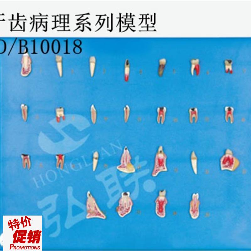 全科医生GDj/B10018牙齿病理系列模型