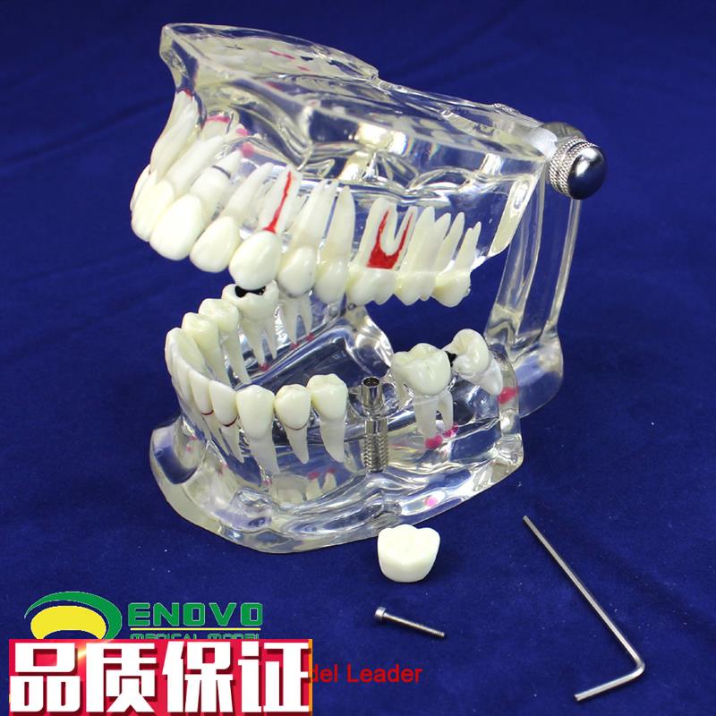 ENOVO颐诺牙齿l模型口腔牙齿科种植模型口腔病理模型种植体牙冠义