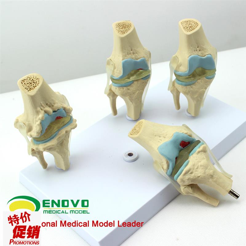 颐诺正品人体病理膝关节模型血友病退F行性膝关节病发炎膝关节模