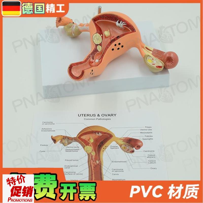 德国】女性子宫卵巢病理病变模型生殖I科妇产科教学计生医学教学